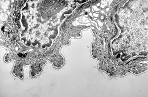 F, 41y. | epidermolysis bullosa … dystrophic type F, 41y. | epidermolysis bullosa … dystrophic type